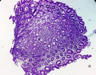 Histopathology, Biopsy Soft Tissue