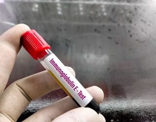 IgE Immunoglobulin, Serum