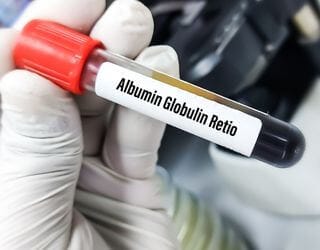 Total Protein, Serum (Albumin, Globulin, A_G Ratio)