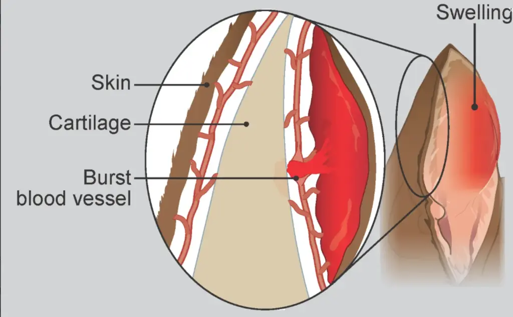 Pictorial Diagram showing rupture of blood vessels of the ear